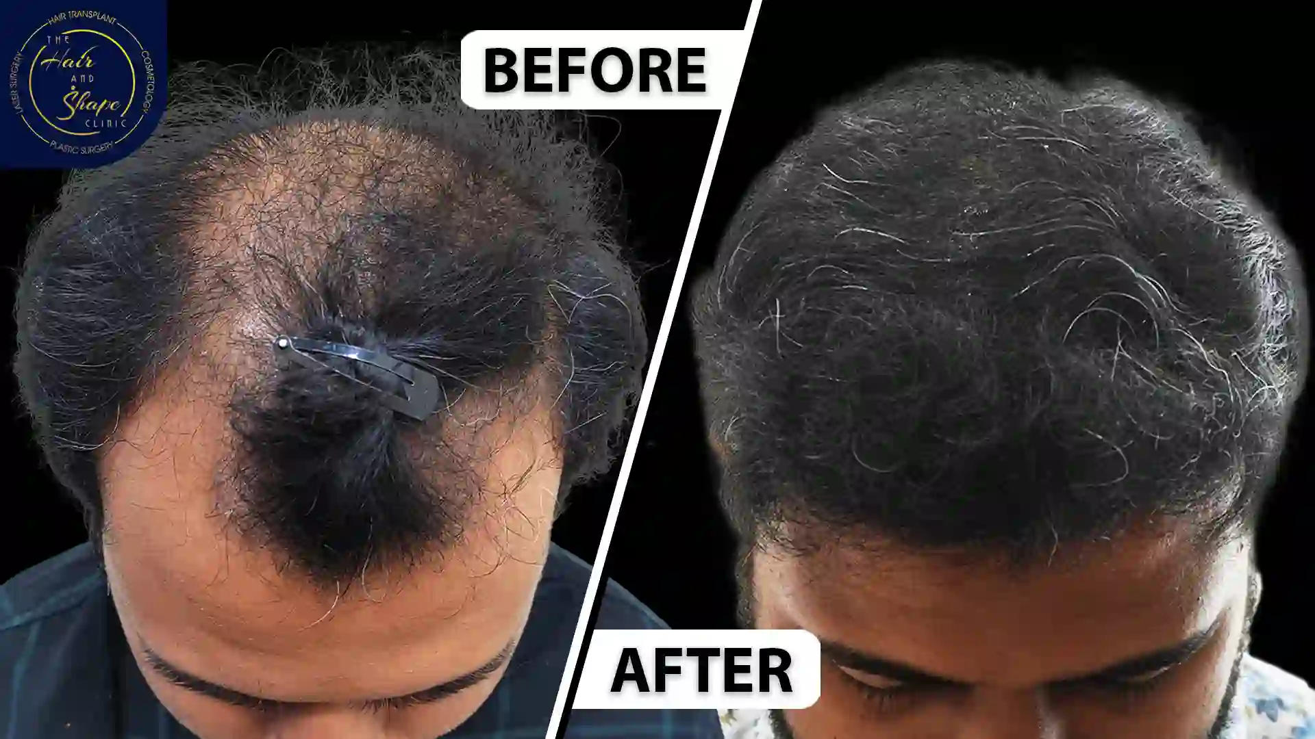 Hair Transplant result35